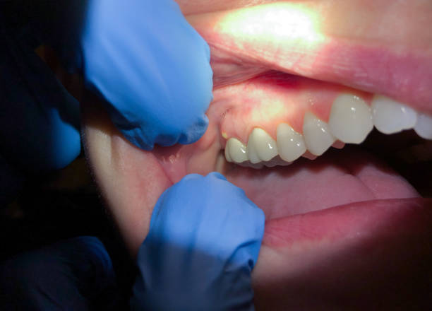 Best Emergency Treatment for Dental Infections or Abscesses in Country Homes, WA