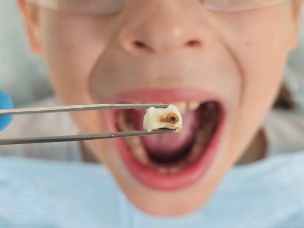 Best Emergency Tooth Extraction in Country Homes, WA